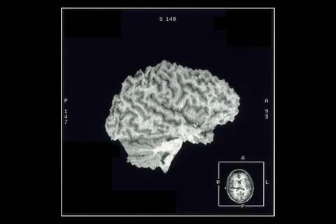  Cerebral cortex, mri Normal cerebral cortex, right lateral view. 3D recon... Stock Photos