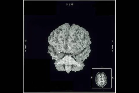  Cerebral cortex, mri Normal cerebral cortex, anterior view. 3D reconstitu... Stock Photos