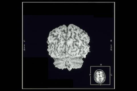  Cerebral cortex, mri Normal cerebral cortex, posterior view. Computer-gen... Stock Photos
