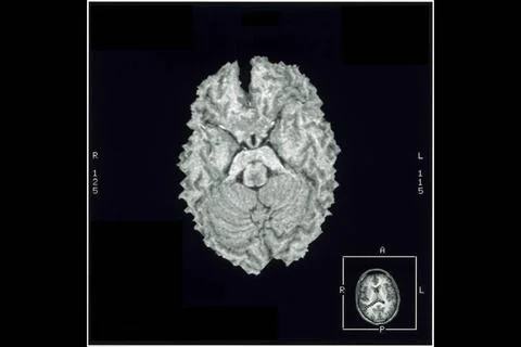  Cerebral cortex, mri Normal cerebral cortex, inferior (bottom) view. Comp... Stock Photos