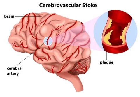 Cerebrovascular Stroke Stock Illustration