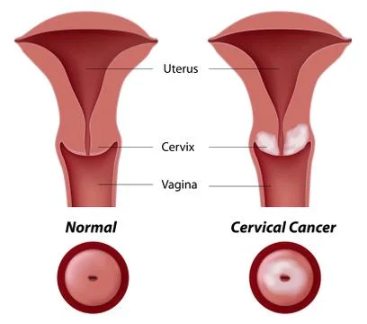 Cervical cancer Illustrazione stock