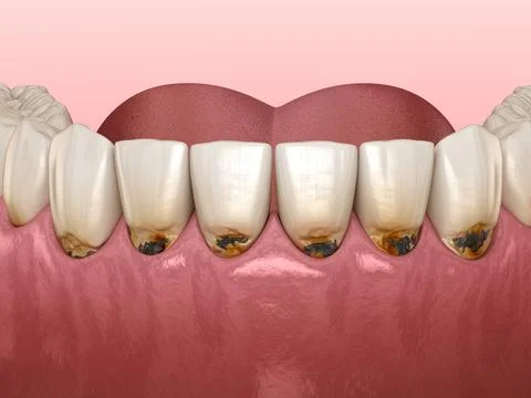 Cervical caries on frontal teeth. Medically accurate tooth 3D illustration. Stockillustratie