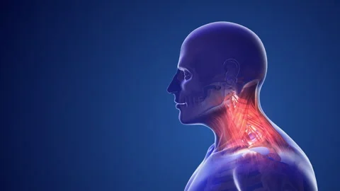 Cervical postural syndrome or neck pain Stock Footage 244175938