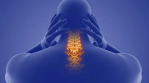 Cervical Posture Problems Contributing to Neck Pain 스톡 동영상 295757259