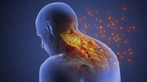 Cervical Posture Syndrome Causing Neck Strain Stock Footage 306427928