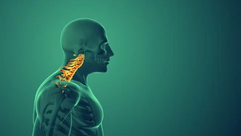 Cervical posture syndrome or neck pain medical background Stock-Footage 242968095
