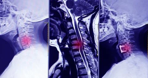 Cervical spine 3 views Stock Photos