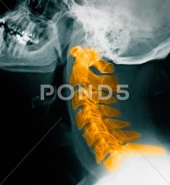 Cervical Spine X-Rays, Normal