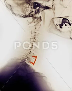 Cervical Spine Xray, Spinal Fusion, Screws, Plate