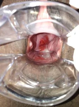 Cervix showing ectopia Foto stock