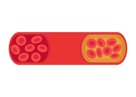 Change of vessel from normal to cholesterol-blocked artery. Blood clot, thrombus Stock Illustration