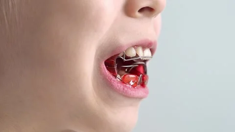 Changing the position of the lower jaw using a removable orthodontic appliance.  Stock Footage 256916477