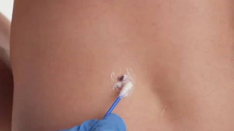 Checking benign moles. Close up detail of the bare skin on a man back Stock Footage 202590297