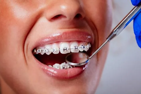 Checking Braces Stock Photos