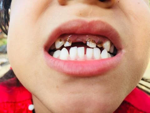 Checking of dental infection and toothache.Decayed tooth,Dental problem. Stock Photos