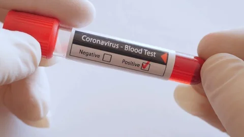 Checking positive result of blood test for coronavirus, covid-19, sars-cov-2 Stock Footage 125766178