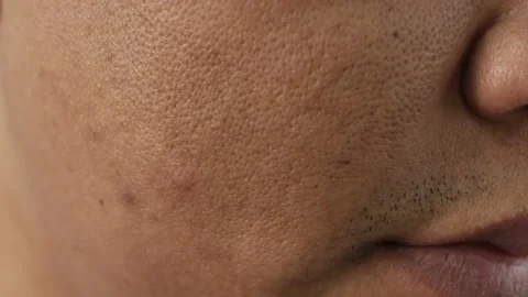 Cheeks of people with skin problems, acne, large pores and dull skin Stock Footage 229276056