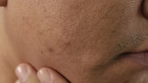 Cheeks of people with skin problems, acne, large pores and dull skin Stock Footage 229276073