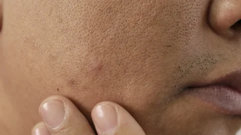 Cheeks of people with skin problems, acne, large pores and dull skin Stock Footage 229276378