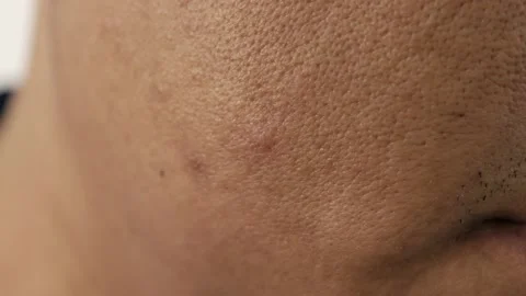 Cheeks of people with skin problems, acne, large pores and dull skin Stock Footage 229276525