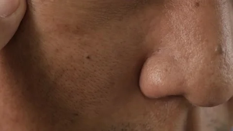 Cheeks of people with skin problems, acne, large pores and dull skin Stock Footage 229276834