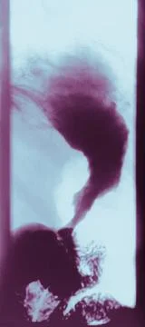  Chemical intoxication Stomach with burns from absorption of liquid bleach... Stock Photos