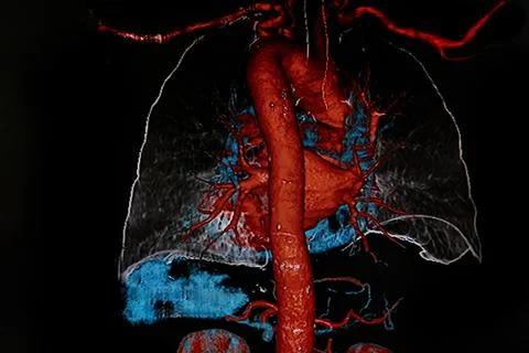 Chest angiography Stock Photos