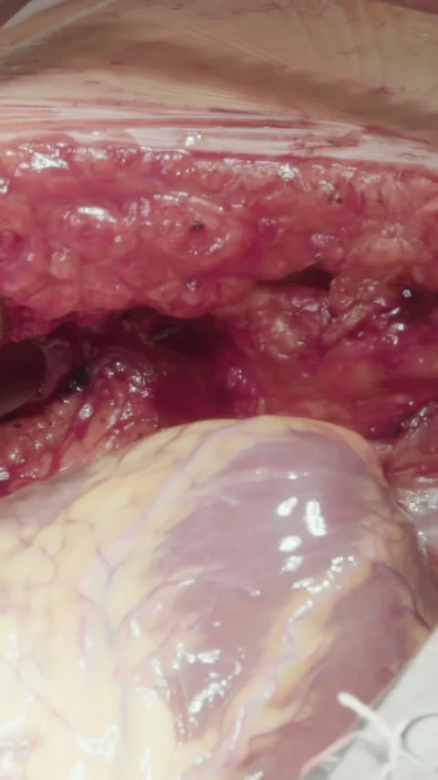 Chest cavity opened with retractors Stock Footage 316510588