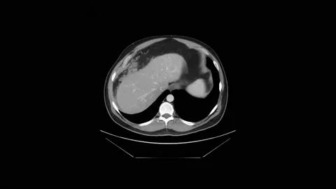Chest CT Scan. MRI Stock Footage 236467071