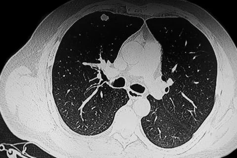 Chest Ct Scan Solid middle lobe nodule Stock Photos