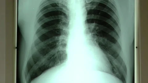 Chest X Ray Appearing on Lightbox, Medical Imaging Activation Sequence Stock Footage 239038489