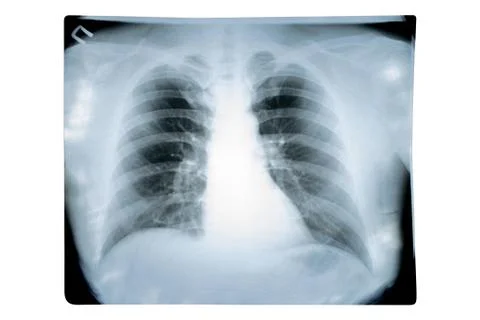 Chest x-ray checking the level of lung damage Stock Photos