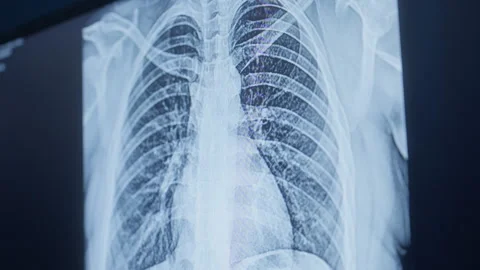 Chest X-ray On Digital Screen. closeup Stock Footage 243905483