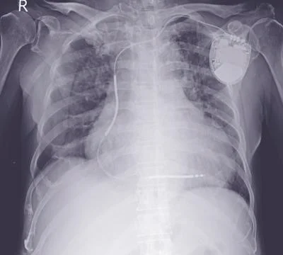 Chest x-ray evere cardiomegaly. Moderate pulmonary congestion. Stock Photos
