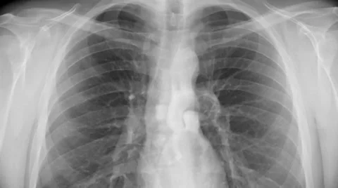 Chest x-ray. Stock Footage