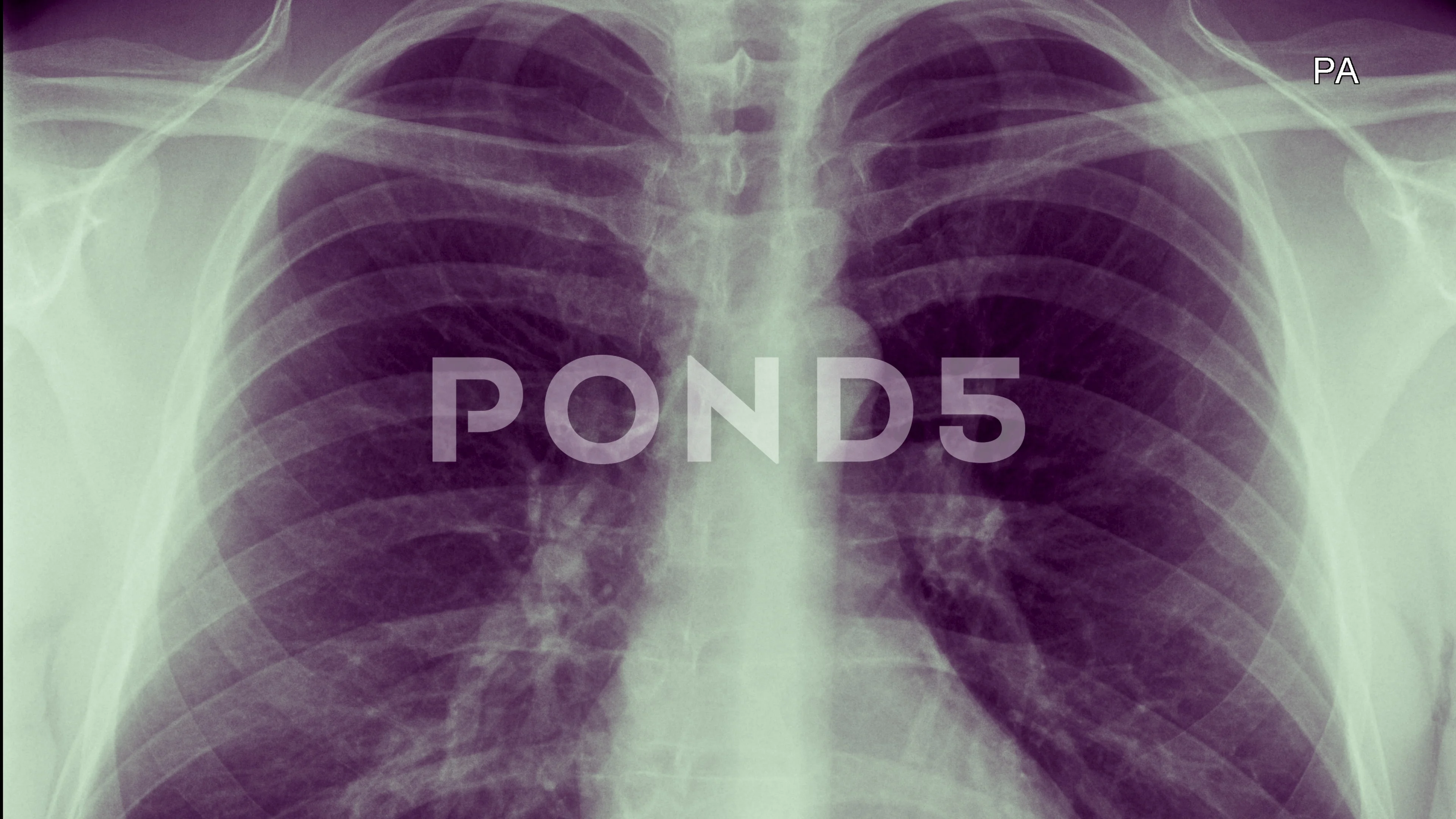 Chest X Ray Human Anatomy Rib Cage Lung Stock Video Pond5