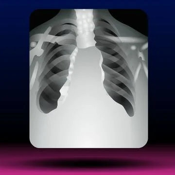 Chest X-Ray Stock Illustration