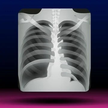 Chest X-Ray Stock Illustration