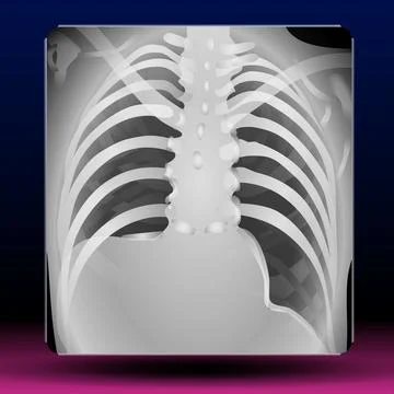 Chest X-Ray Stock Illustration