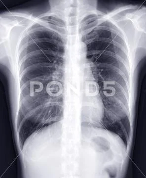 Chest X Ray Image For Diagnosis TB Tuberculosis And Covid 19 Graphic   Chest X Ray Image Diagnosis Illustration 197931017 Iconl 