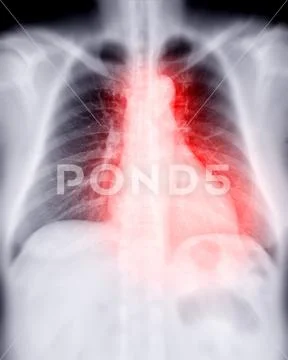 Chest X Ray Image For Diagnosis TB Tuberculosis And Covid 19 Royalty   Chest X Ray Image Diagnosis Illustration 199365102 Iconl 