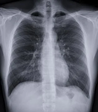 Chest x-ray image. Stock Illustration