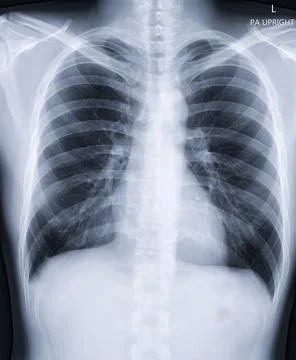 Chest x-ray image. Stock Illustration