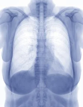 Chest x-ray image Negative filter. Stock Photos