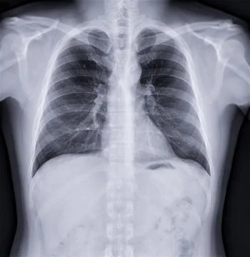 Chest x-ray image , Normal Chest. Stock Illustration
