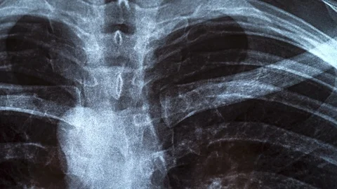 Chest X-ray image for physicians examination Stock Footage 106169934