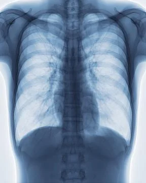 Chest x-ray image for screening diagnosis TB,tuberculosis and covid-19. Stock Illustration