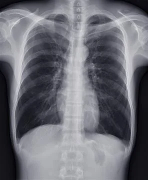 Chest x-ray image for screening diagnosis TB,tuberculosis and covid-19. Stock Illustration