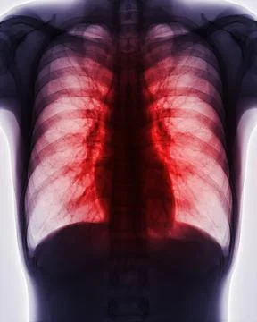 Chest x-ray image for screening diagnosis TB,tuberculosis and covid-19. Stock Illustration